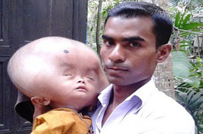 Bangladeşli Emon'un kafası sürekli büyüyor 4