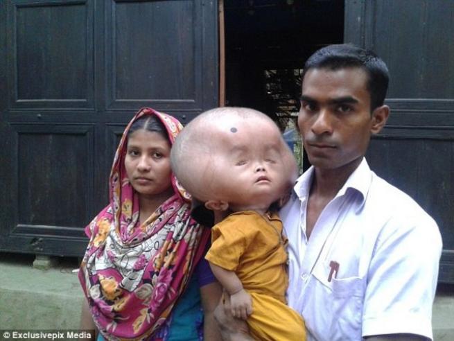 Bangladeşli Emon'un kafası sürekli büyüyor 7