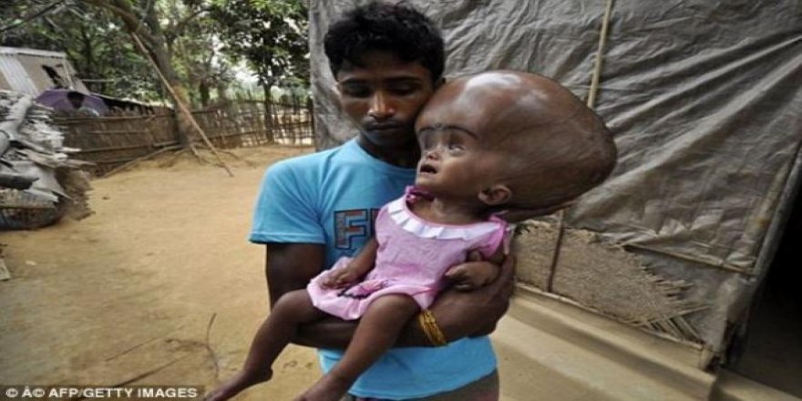 Bangladeşli Emon'un kafası sürekli büyüyor