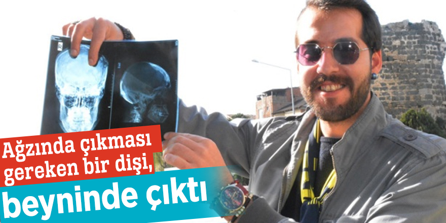 Ağzında çıkması gereken bir dişi beyninde çıktı