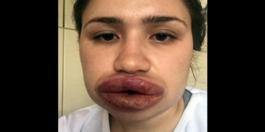 Silikon mağduru hemşirenin son hali şaşırttı
