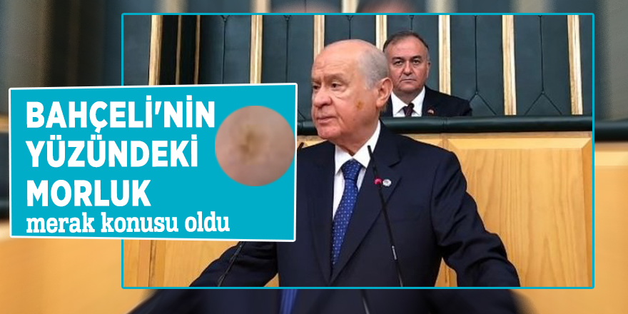 Bahçeli'nin yüzündeki morluk merak konusu oldu