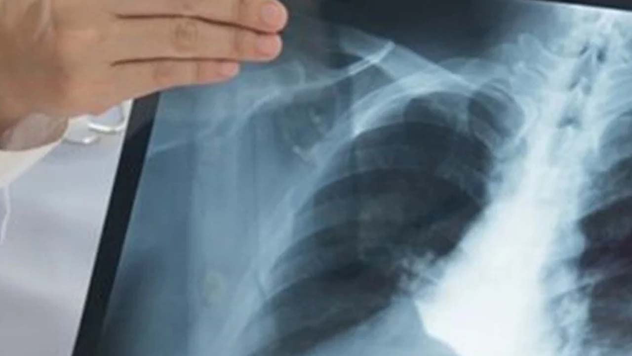 Bir kişi her yıl 10 ile 15 kişiyi enfekte ediyor: İzmir İl Sağlık Müdürlüğü bu hastalığa dikkat çekti!