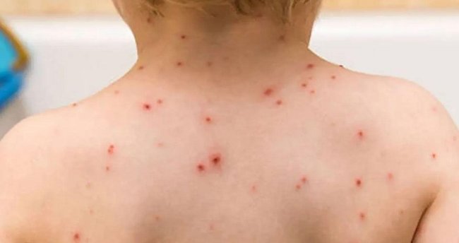 Türkiye Avrupa'nın 1'incisi oldu! SALGIN alarmı  9-18 ay arası çocuklarda KIZAMIK TEHLİKESİ: Uzmanlar UYARIYOR