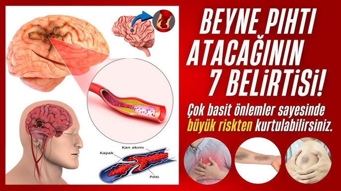 Beyne Pıhtı Atmasının Sinsi İşaretleri ve Acil Durum Rehberi!