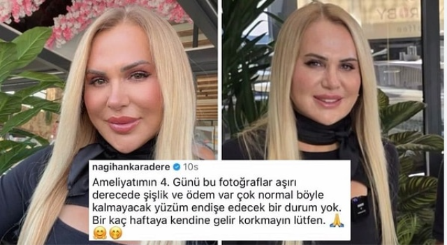 Nagihan Karadere'nin estetik sonrası son hali! “Böyle kalmayacak yüzüm”